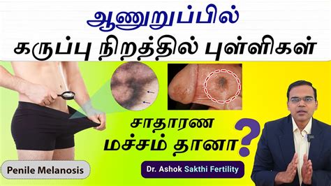what is penile melanosis